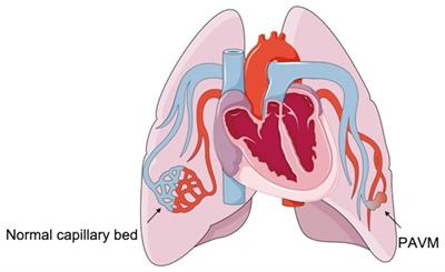 Neurological and cardiopulmonary manifestations of pulmonary arteriovenous malformations